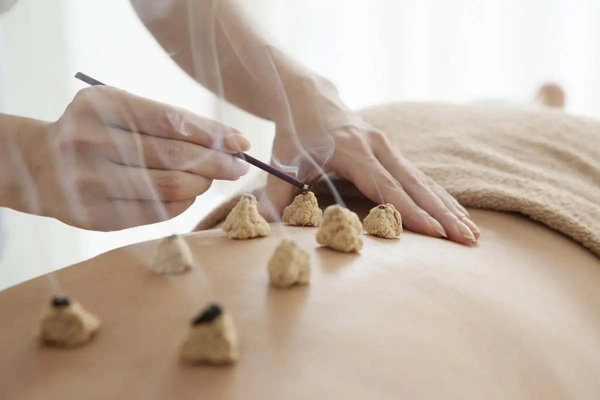 Session de moxibustion sur le dos d'un client